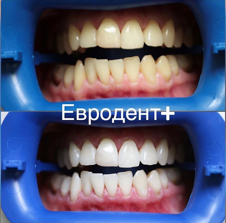 Лазерное отбеливание отзывы. Отбеливание зубов. Отбеливание зубов до и после. Лазерное отбеливание зубов.