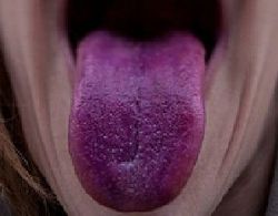 О чем говорит фиолетовый язык
