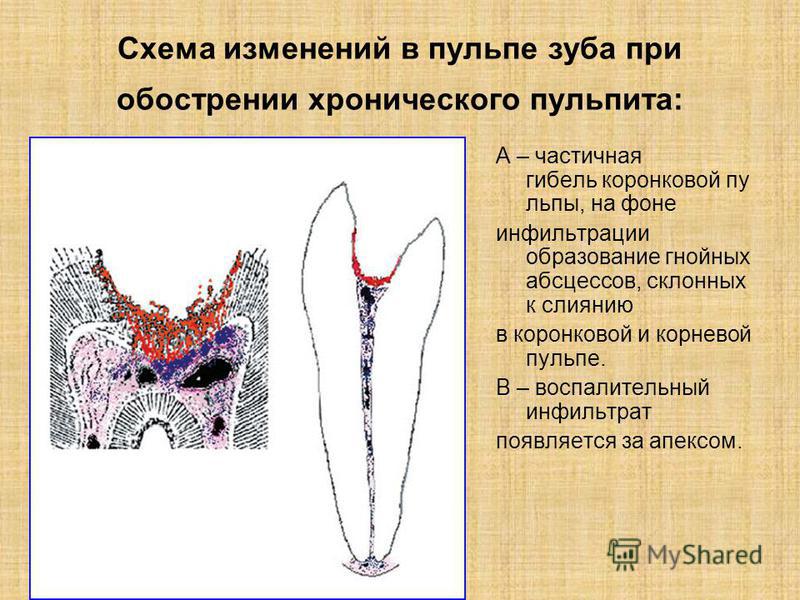 Этиология патогенез пульпита презентация