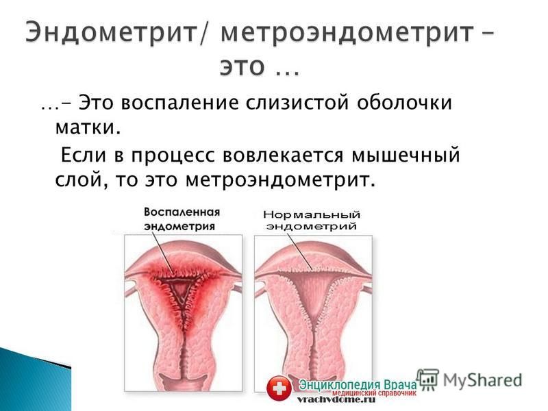 Воспаление матки. Послеродовый метроэндометрит. Эндометрит шейки матки. Воспаление слизистой оболочки матки.