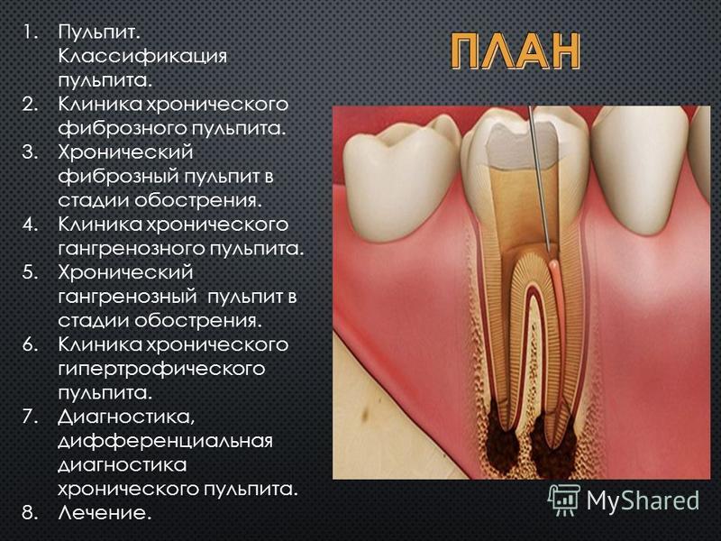 Лечение пульпита Томск Рабочая 1-я Отбеливание зубов Томск Жигулевская