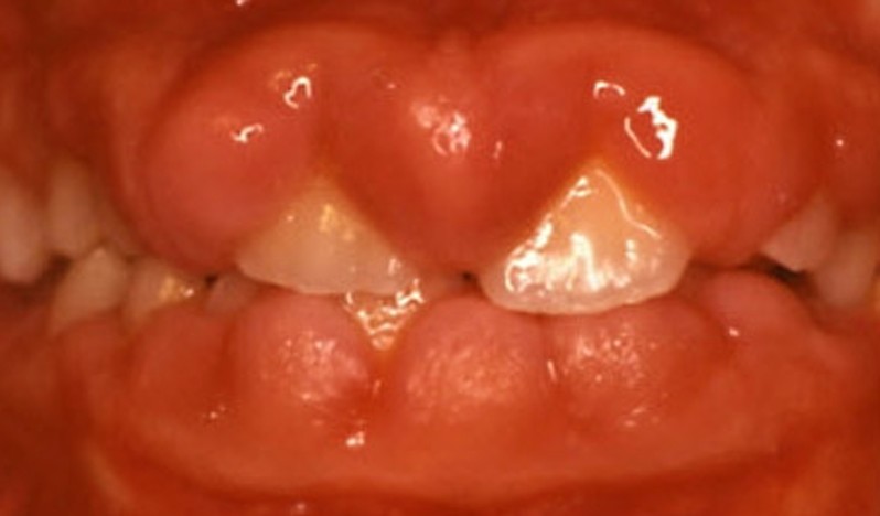 gingival hyperplasia pictures 2