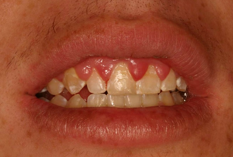 gingival hyperplasia pictures 3