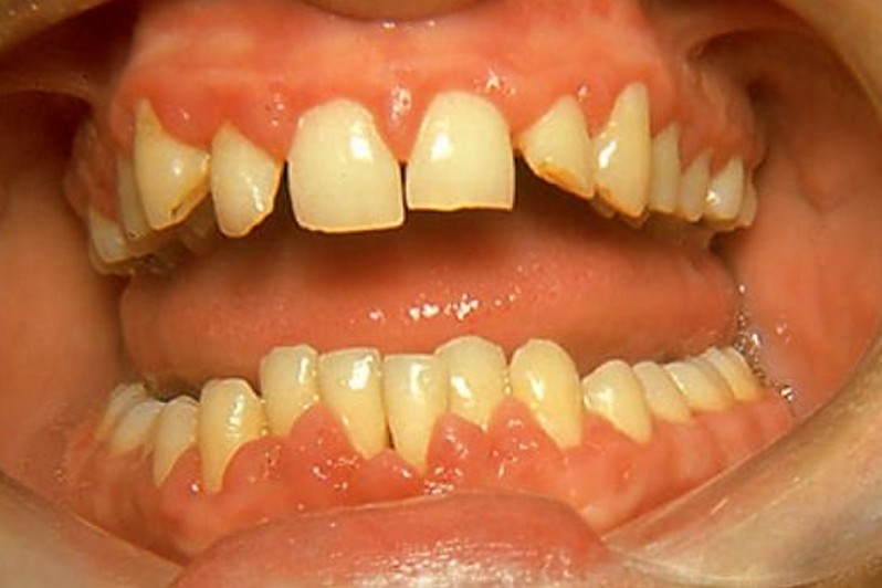 gingival hyperplasia pictures 4