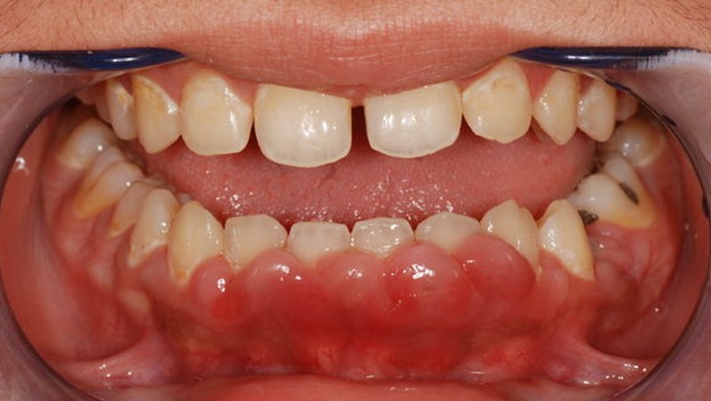 gingival hyperplasia pictures 5