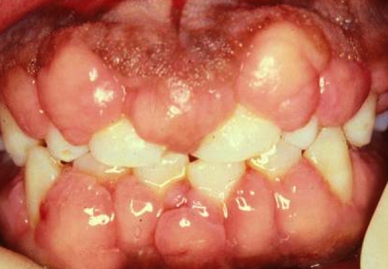 gingival hyperplasia pictures