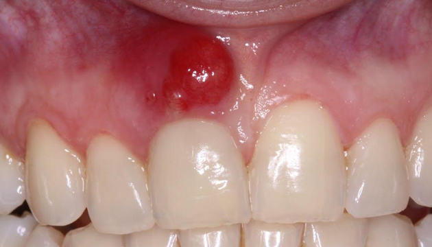 На фото показана киста зуба