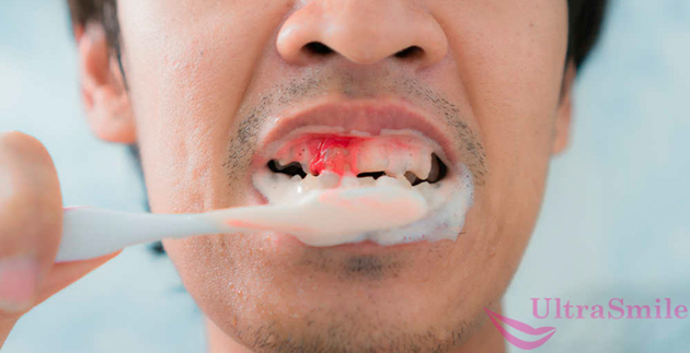 при чистке зубов кровоточат десны
