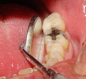 An Amalgam aka Silver Filling