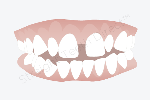 teeth gaps
