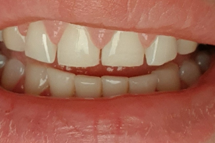 Какое расстояние между зубами. Щель между передними зубами. Маленькая щель между передними зубами.