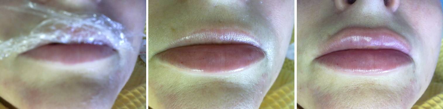 Удаление малых губ до и после фото. Синяки после гиалуроновой кислоты ГУ. Гематомы после увеличения губ. Синяки после увеличения губ.