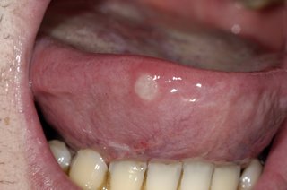 White/grey round sore on the side of a tongue poking out of mouth