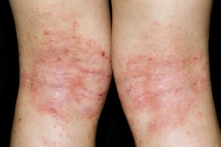 Eczema on the knees