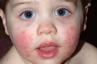 Bright red spots on childs cheeks