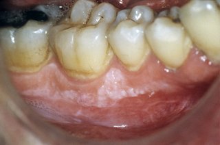 A faint white patch on the gums, just below the teeth