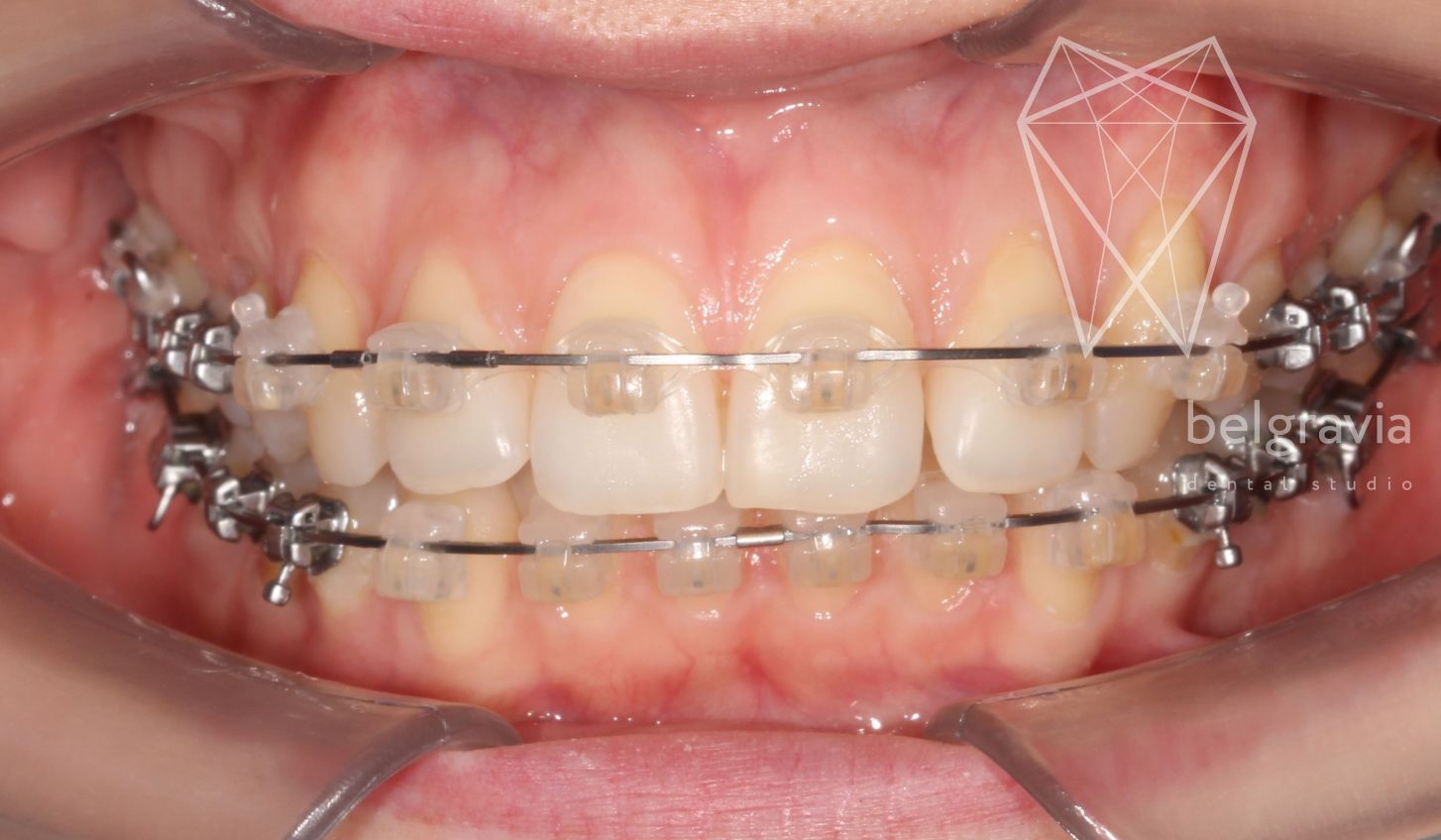 Simply orthodontics marlborough