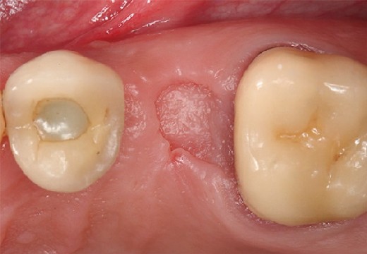 рана после удаления зуба