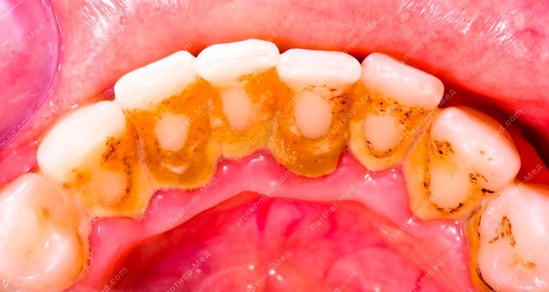 причина кровоточивости десен при чистке зубов зубной камень
