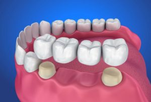 Схема моста для зубов