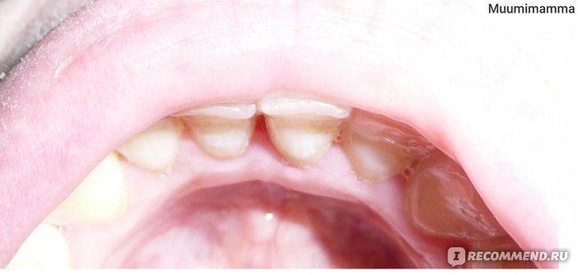 Удаление зубного камня, после процедуры, видно поврежденную десну спустя несколько дней.