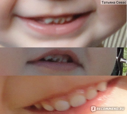 Серебрение молочных зубов Томск Костромская Лечение кариеса лазером Томск Ишимский