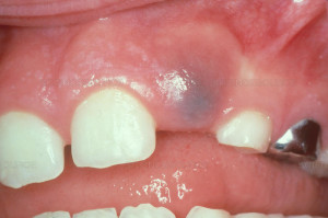 киста прорезывания - виды кисты зуба
