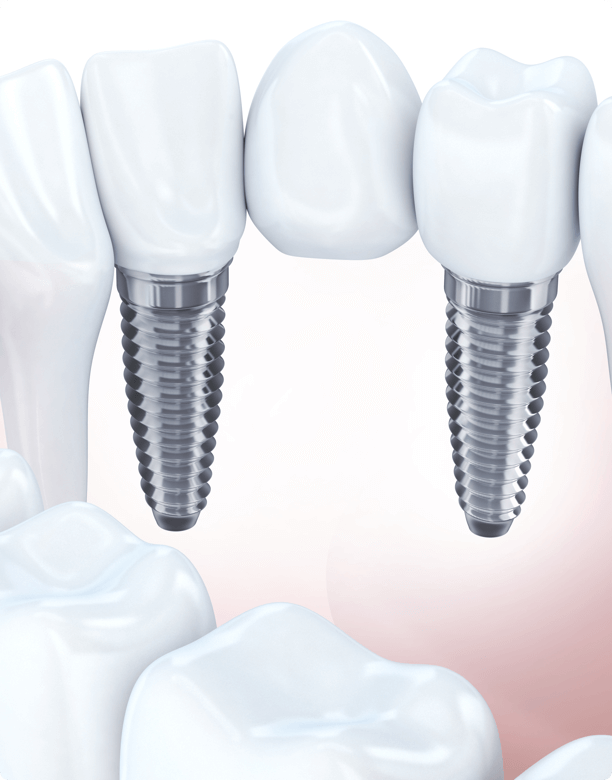 Имплант c4012m. Имплант зуба абатмент. Три импланта на один штифт.