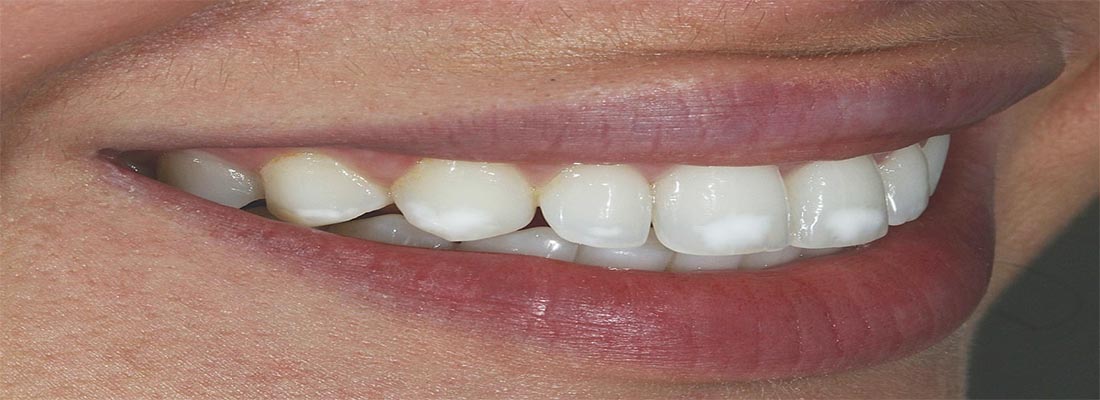 Как избавиться от белых пятен на зубах
