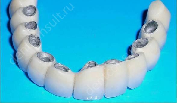 Срок службы зубных имплантов