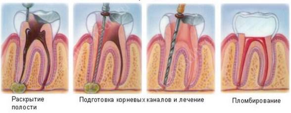 На фото показан процесс лечения воспаления корня зуба