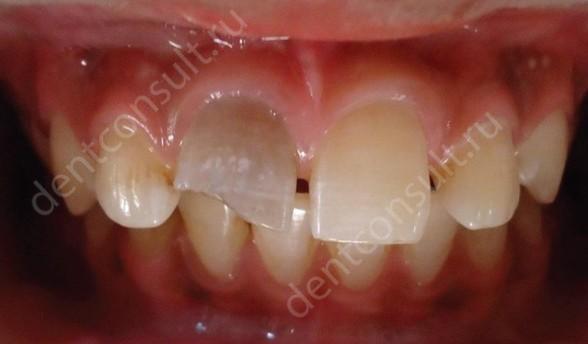 Фото: травма зуба, как причина воспаления 