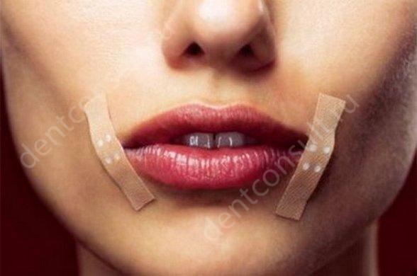 Фото: аппликации на уголки губ
