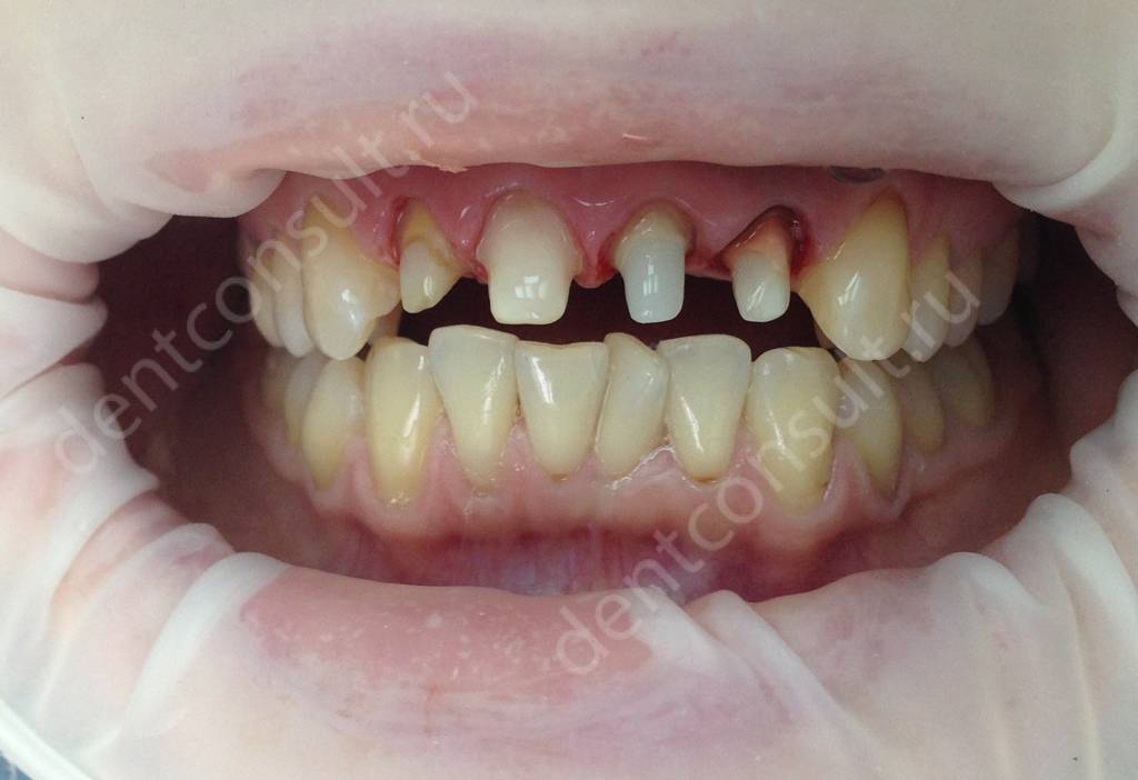 Обточка зубов