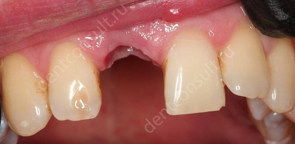 Опухоль после удаления зуба