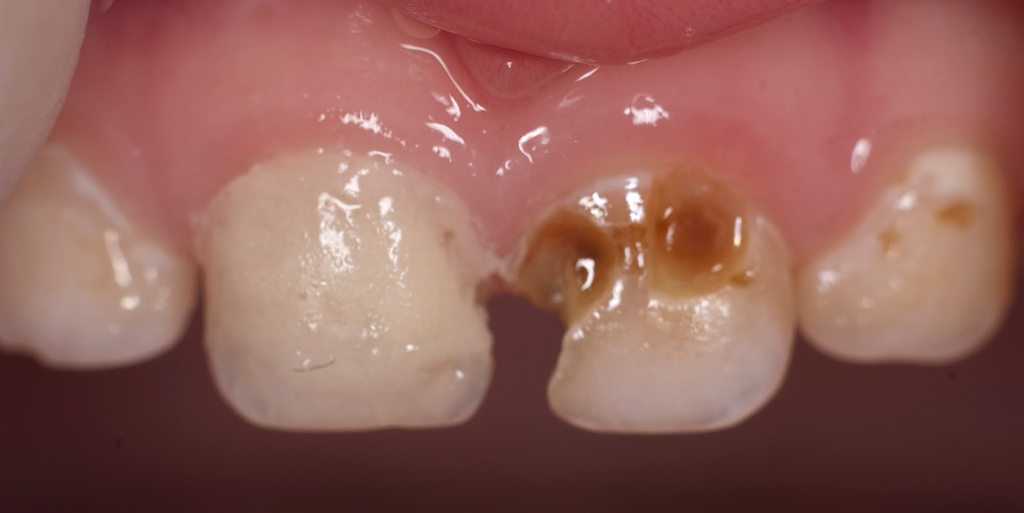 Молочные зубы больше подвержены поражению кариесом, чем постоянные