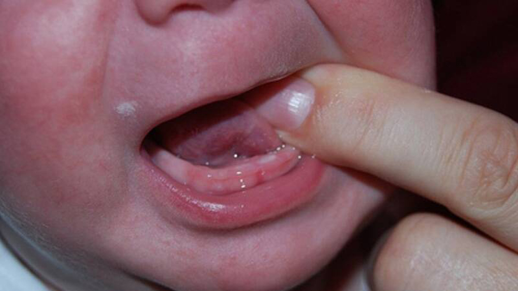 Прорезывание первых зубов - большое испытание для ребенка