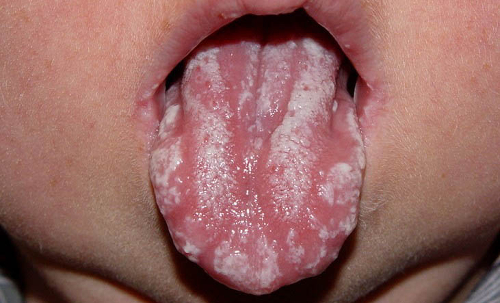 Грибковая инфекция на языке