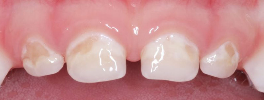 Заболевание может проявится с появлением первых зубов