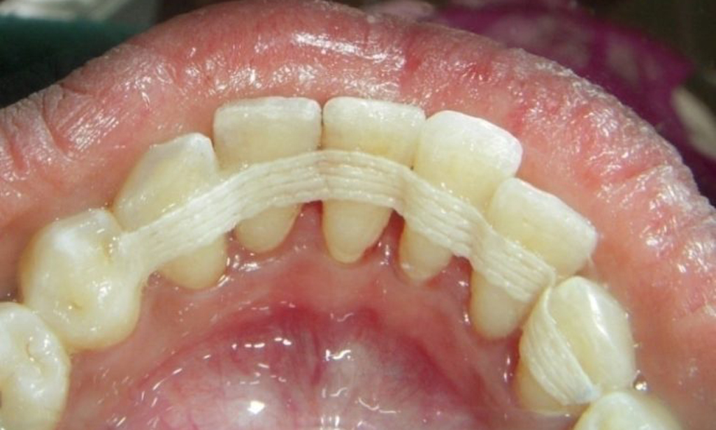 В некоторых случаях спасти зубы может шинирование