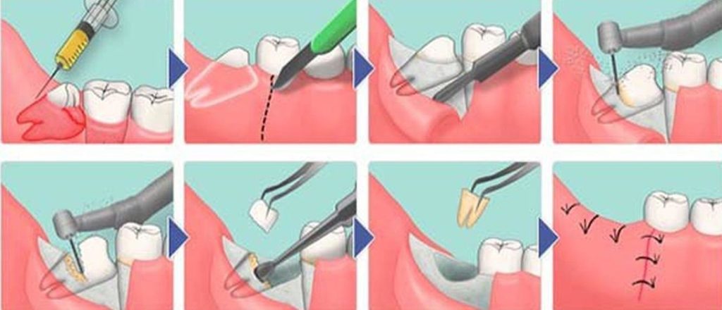 Схема удаления зуба