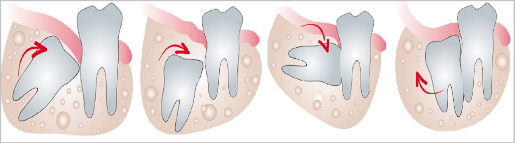 Ретинированный зуб может расти в различных направлениях