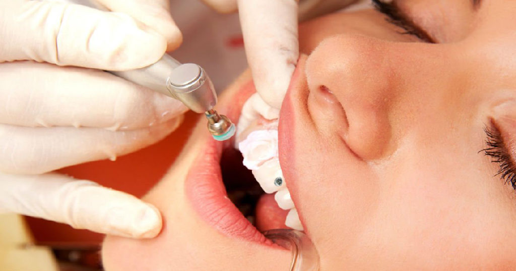 Чистка зубов у стоматолога является важным этапом в лечении