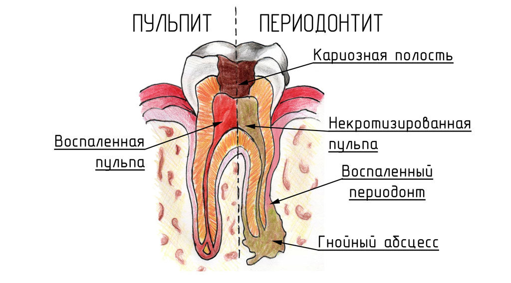 Что делать если опухла щека, но зуб не болит