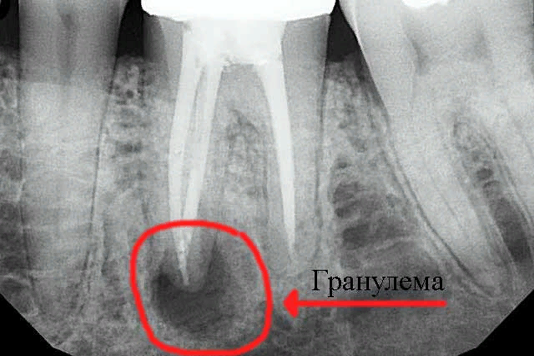 зубная гранулема