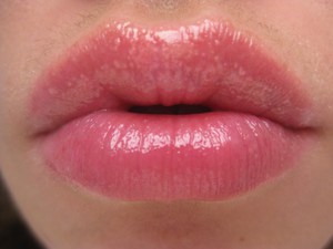Лечение белых точек на губах
