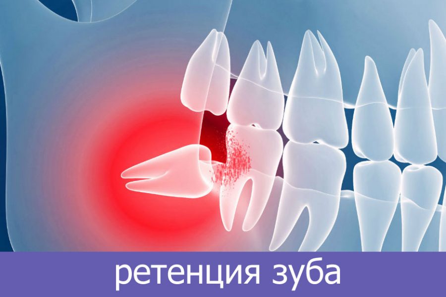 ретенция зуба
