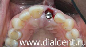 установка импланта зубного сразу после удаления зуба (одномоментная имплантация)