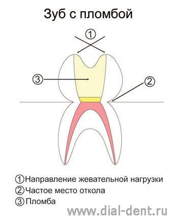 пломба на жевательном зубе
