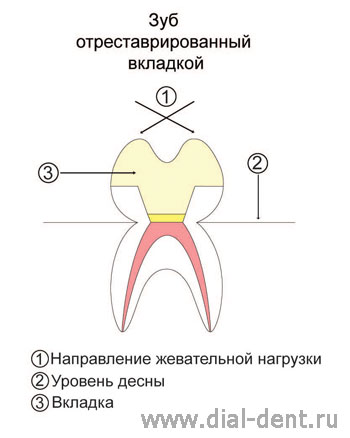 вкладка на жевательном зубе